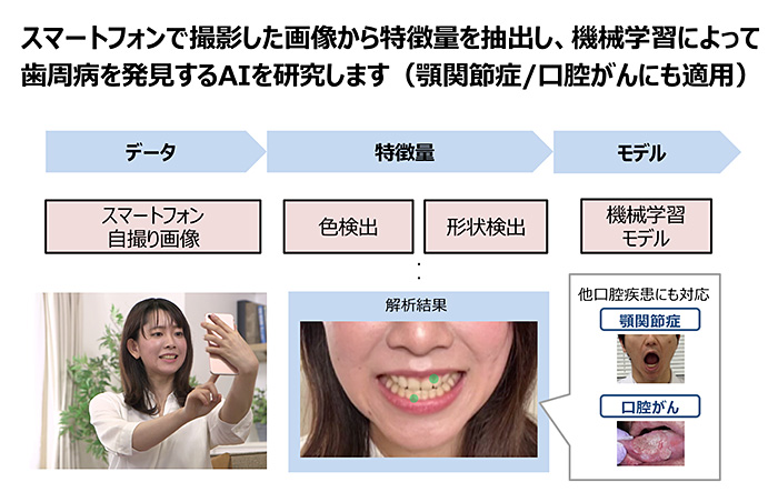 スマホで歯ぐき撮影→AIが歯周病発見、ドコモと東北大が共同研究